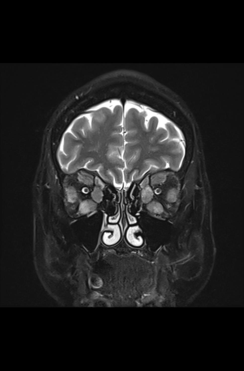 Endokrine Orbitopathie