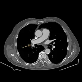Lungenarterienembolie