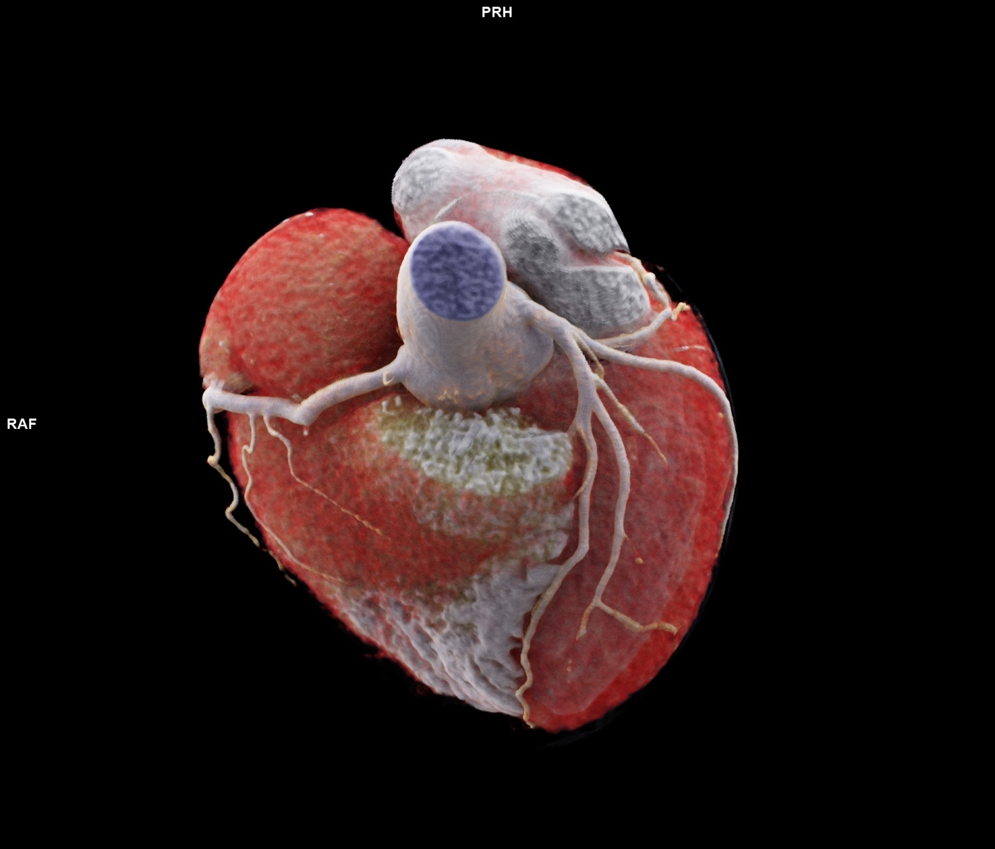 Cinematic Rendering der Koronargefäße basierend auf einer EKG getriggerten CT-Angiographie mit intravenöser Kontrastmittelgabe. Copyright Siemens Healthineers