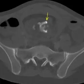Reifes ovarielles Teratom
