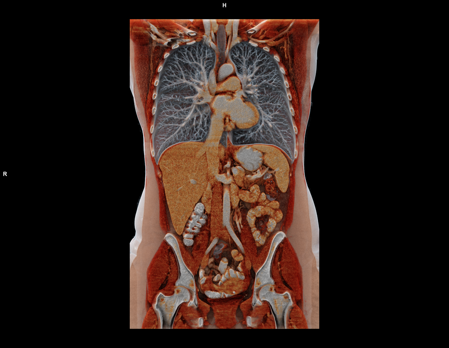 Rendering des Thorax und Abdomen (Bauchraum) basierend auf CT-Scan mit Kontrastmittelgabe. Zur besseren Darstellung von Magen und Darm wurde zusätzliches Kontrastmittel oral verabreicht. Copyright Siemens Healthineers